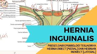 hernia inguinalis lateralis dan medialis